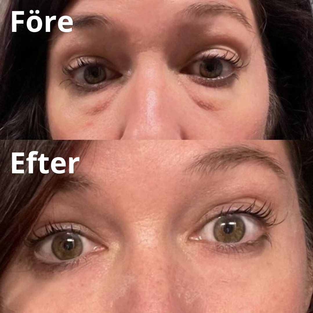 Collagen eyepatches