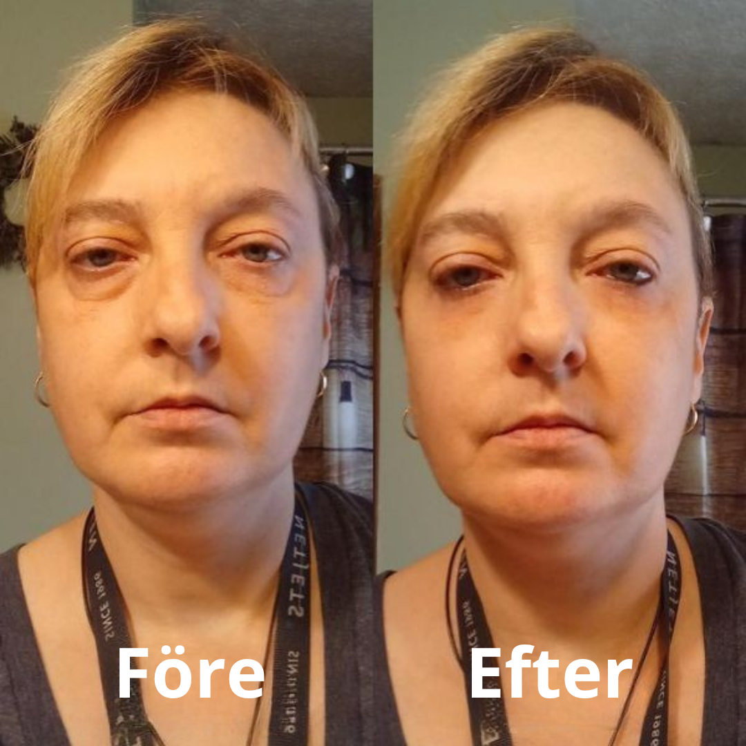 Collagen eyepatches